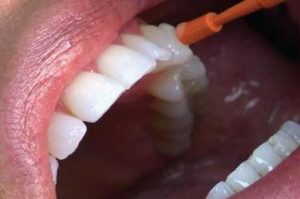 причины появления чувствительности зубов